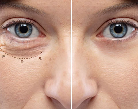 Rejuvenecimiento Facial Con Laser Co2