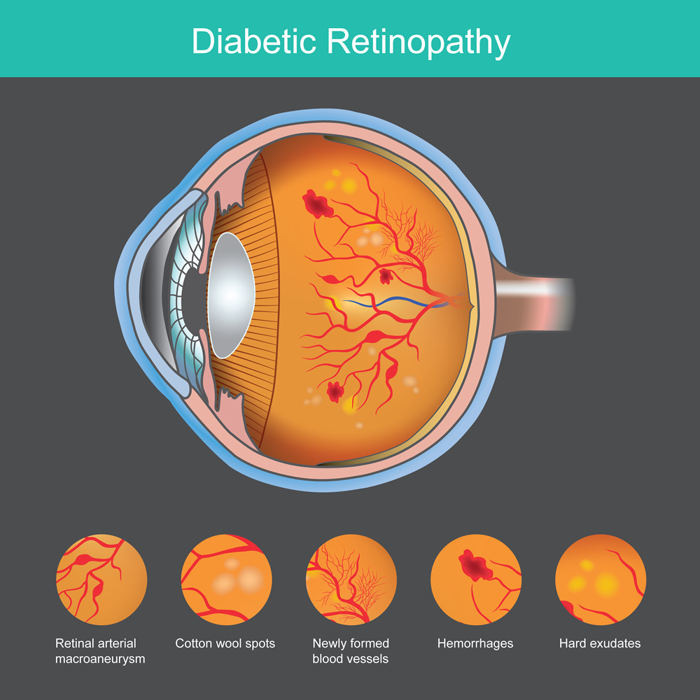 Esquema Retinopatía Diabética