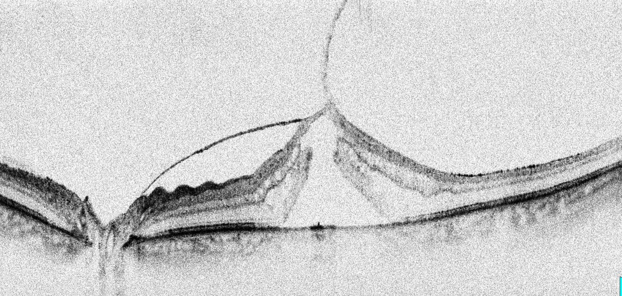 Epiretinaalisen kalvon leikkaus: näön vakauttaminen ja oireiden parantuminen – SolEyes