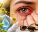 Conjuntivitis alérgica con enrojecimiento y lagrimeo ocular
